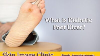 What is Diabetic Foot Ulcer? – skin